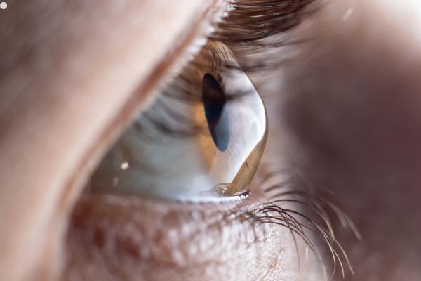 Lentes para Queratocono en Quito